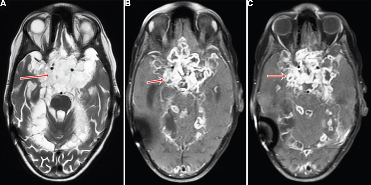(A) T2-weighted magnetic resonance image of brain showing multiple lesions of varying intensity in the optochiasmatic region (red arrow). (B & C) Post-contrast T1 image showing multiple peripherally enhancing lesions in the optochiasmatic area (red arrow).